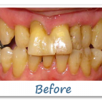 Before Dental Implant